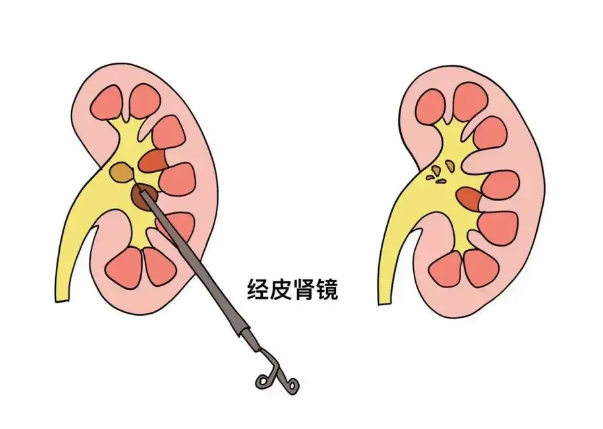 肾结石怎么治疗效果好？专家：肾结石治疗方式大揭秘，建议收藏！【四川肾结石专科医院】(图5)