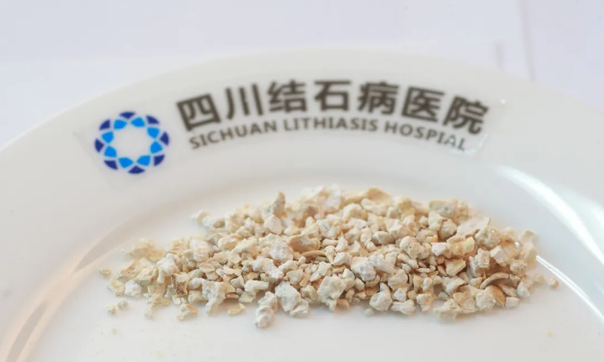 科学防石有秘诀！做好这几点，夏季远离泌尿结石困扰【四川肾结石专科医院】(图2)