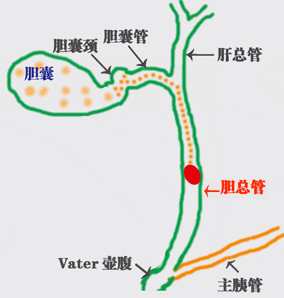 胆囊结石想靠碎石排石？四川结石病医院陈红春主任：此路行不通，别踩坑！(图2)