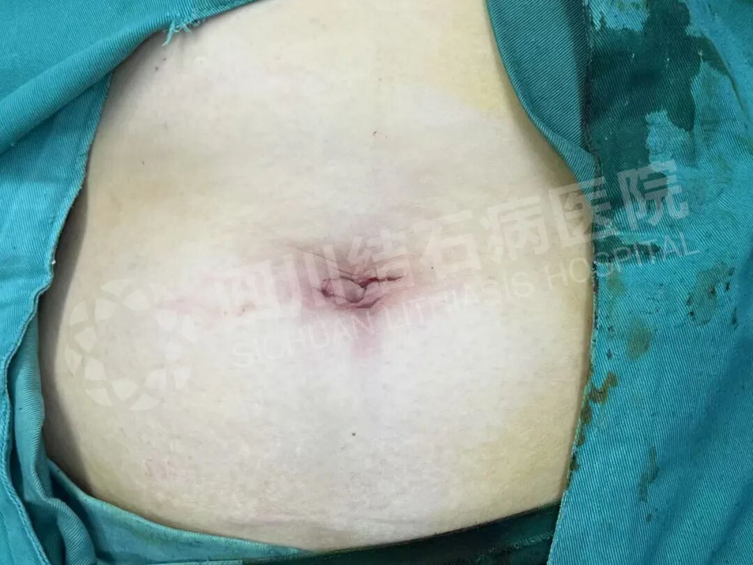 怕留疤?怕切胆?经脐隐瘢痕技术实现“鱼与熊掌兼得”【四川结石病医院】(图2) 怕留疤?怕切胆?经脐隐瘢痕技术实现“鱼与熊掌兼得”【四川结石病医院】(图2)